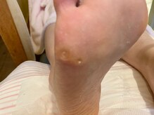 ビサンテ サロン/愛知,岐阜,三重で角質ケア人気-3