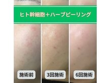 スキンベイビー 浦和店(Skin Baby)/ヒト幹細胞＋ハーブピーリング