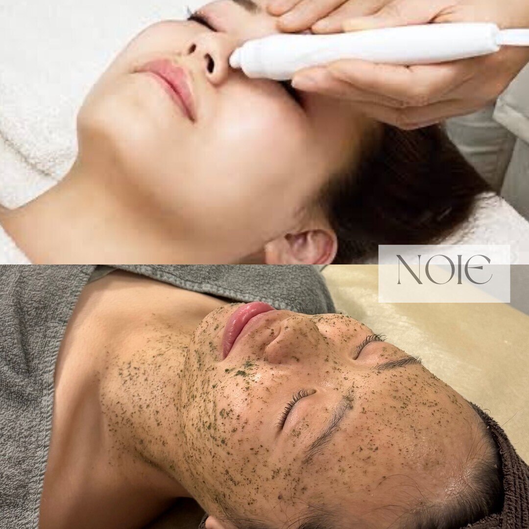 ハーブピーリング 20代のお客様》 両方施術前 クレンジング終わったあとのお写真