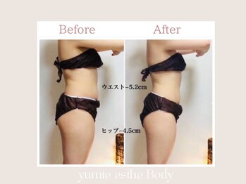 トータルビューティー ゆみえエステ(Total Beauty)/痩身 サイズダウン