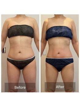 セレア(CELEA)/内臓脂肪/お腹集中/くびれ