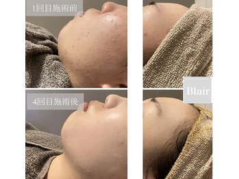 ブレア(Blair)/生ハーブピーリング
