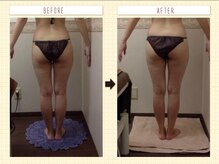 エステティックサロン ピュール ボーテ 東金店/ハイパーナイフ