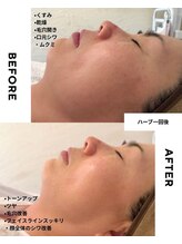 エステサロン アンジュール(Angelle)/ハーブ1回目直後のお肌