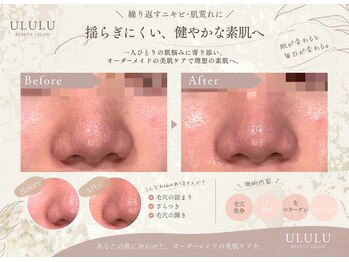 ウルル 四日市駅前店(ULULU)の写真/【毛穴詰まりを改善】超音波毛穴洗浄器で肌への負担を最小限に。つるんっと肌を目指す☆