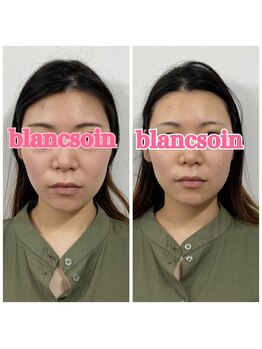 ブランソワン/１回でフェイスラインがスッキリ