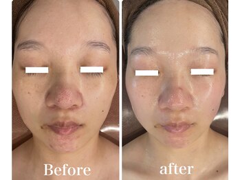 オレアグリーン 岡崎(OLEA green)/ブラックハーブ8回