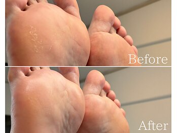 カシェット 広島店(Cachette)/40代女性☆足裏角質ケア90分