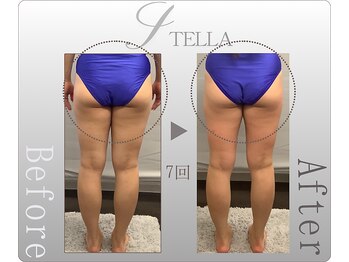 ステラ(STELLA)/下半身プレミアム7回の効果