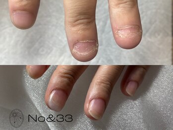 ナンバーアンドスリーサン(No&33)の写真/【深爪・かみくせ・薄い爪】もう隠さない！自爪育成で「強く美しい指先」へ