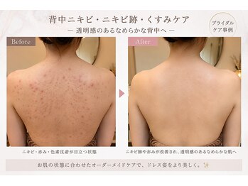 ベルビー エルエル岡崎店/背中肌質改善
