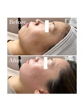 ホワイトワックス 京都四条烏丸(WHITE WAX)/全顔フェイシャルワックス