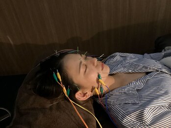 ハリステラ(HariStella)/★リフトアップ【ステラ美容鍼】