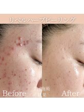 リフィール(Re:feel)/諦めなければお肌は変わります！