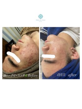 サロンドシェリ(salon de cheri)/2Bハーブピーリング