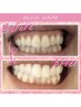 【11/9.10.11限定】継続率90%☆セルフホワイトニング(9分2セット)¥8800→¥390