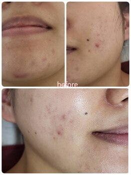 ピウリ(PIURI)/[効果]ニキビケア専用ピーリング