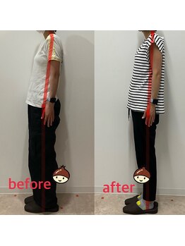 まろん鍼灸接骨院 立川店/姿勢矯正　Before→After！