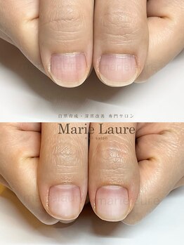 マリーロール 淀屋橋本店(Marie Laure)/自爪育成/深爪矯正/ネイルケア
