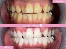 エクシアホワイトニング 札幌中島公園店/Before After［ホワイトニング］