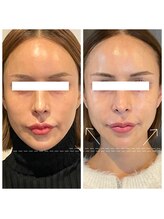 レミュー(remiu)/小顔テラボーラー