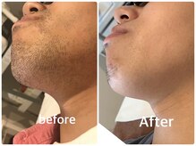 メンズ シャンティ(Men s SHANTI)/【30代男性】脱毛　Before/after