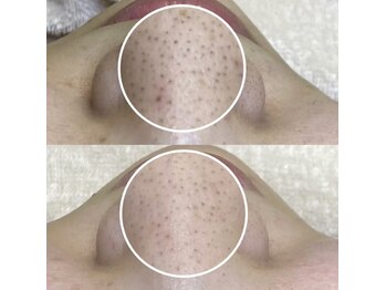 ビオルブ(VIOLVE)/毛穴エクストラクション