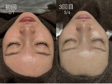 ビビ(Vivi)/3回施術でここまで変化！