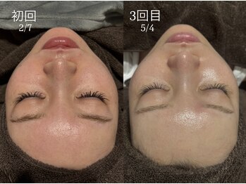 ビビ(Vivi)/3回施術でここまで変化！