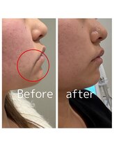 エピリア(Epilear)/リフトアップコース