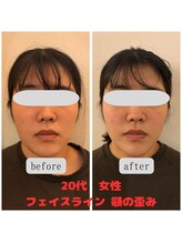 まつもと美容鍼灸整体サロン/【美容鍼】Before/After