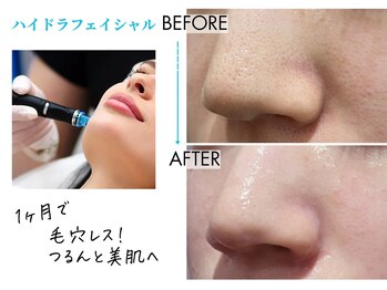 キレイベース 銀座店(KIREI BASE)/ハイドロフェイシャル 1ヶ月