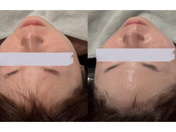 リズ(rE:S)/プラズマ韓国リジュラン/30代