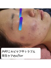 ピウリ(PIURI)/MADニキビケアトラブル中の方も