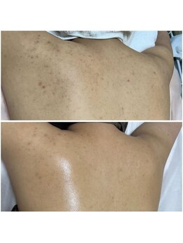 オアジスパ(Oasi Spa)/Greenpeel １回ブツブツあと