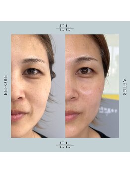 サロン ド ラヴィエール(salon de Laviere)/最新/医師監修/新潟エクソリフト