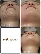 ベビースキン(baby skin)/肌改善