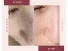 【モニター様50％OFF】ニキビケア　5,500→2,700 30分