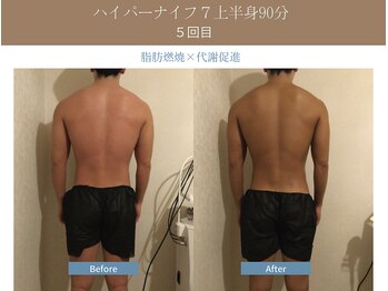 漢方アロマヒーリングサロン 浦和店(漢方AROMAヒーリングサロン)/ハイパーナイフ7上半身◆5回目