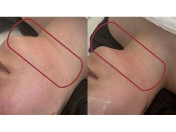 アクアリジェの写真/【桑名発】レモンボトルに次ぐ《最新脂肪分解レッドショット》ほうれい線/たるみを徹底ケア!驚きのハリ◎