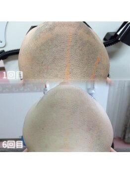 celeria【セレリア】 【11月中旬 NEW OPEN(予定)】の写真/【脱毛×美肌のWアプローチ】痛みの少ない最新脱毛&美肌効果 お財布に優しい都度払いで理想のツルスベ肌へ