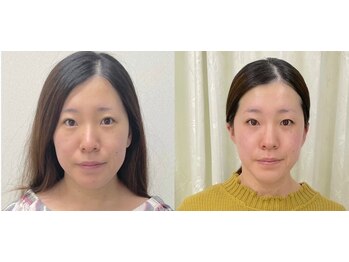 ワイサロン(Y salon)/【小顔症例】コルギ/10回目