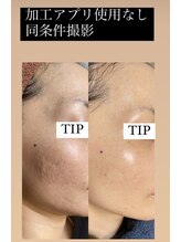 プランス 恵比寿店(PLANCE)/恵比寿/ハーブピーリング