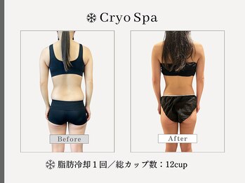 クリオスパ せんげん台駅前店(Cryo Spa)/脂肪冷却