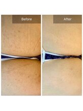 ビビ(VIVI)/お尻ケアにハーブピーリング