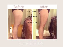 トータルビューティー ゆみえエステ(Total Beauty)/痩身/ハイパーナイフ　お尻・足