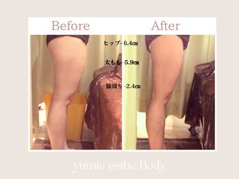 トータルビューティー ゆみえエステ(Total Beauty)/痩身/ハイパーナイフ お尻・足