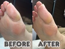 ポドロ ウィズ ニコルル 大阪天満店(PoDoLo with Nicolulu)/【角質/たこ】フットケア大阪