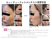 アドミーロ/ニキビトラブルもお任せ★