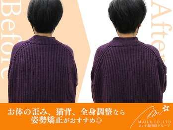 まいれ鍼灸整骨院 整体院 長浜院/姿勢矯正ビフォーアフター
